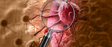 Moderne Diagnostik bei Verdacht auf Prostatakrebs: MRT-3D-TRUS-Fusionsbiopsie Beispielbild
